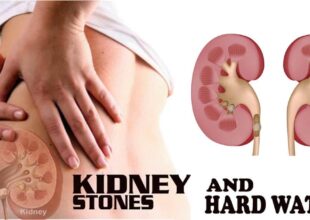 Myth or Reality- Are Kidney Stones Caused by Hard Water?