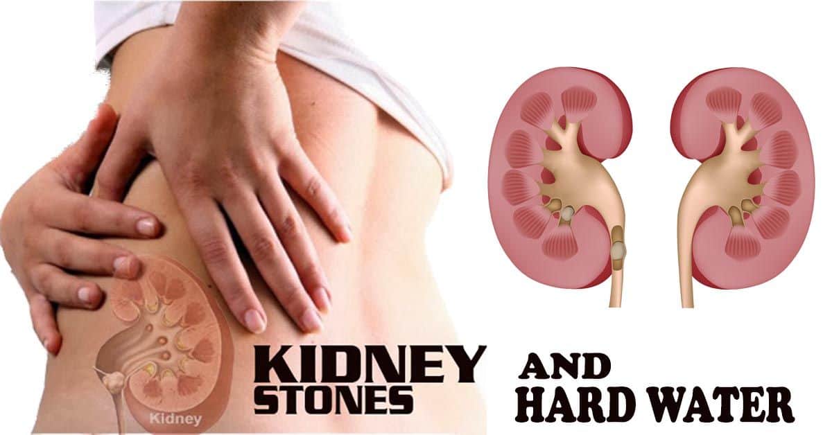 Myth or Reality- Are Kidney Stones Caused by Hard Water?